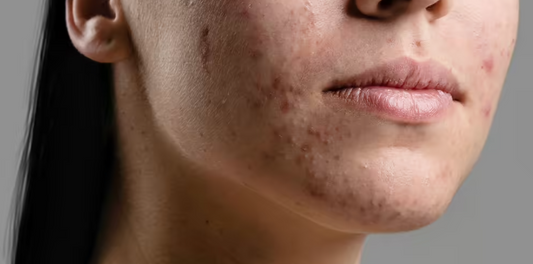Acne and Blemishes