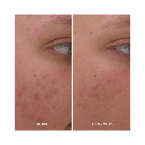 Mejora visible en el acné después de 2 semanas de usar Clear Rescue Serum. Las imágenes de antes y después muestran un enrojecimiento reducido y una piel más suave.