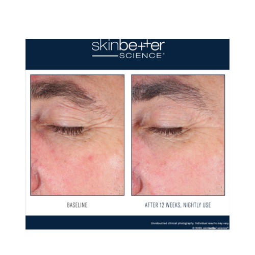 Synlig forbedring i øjenområdet efter 12 ugers natlig brug af Skinbetter EyeMax AlphaRet Overnight Cream, hvilket reducerer fine linjer og hævelser.