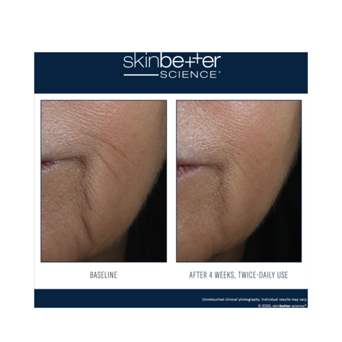 Synlig forbedring i hudtekstur og rynkedybde vist i Skinbetter Interfuse Lines serum kliniske resultater etter konsekvent bruk.