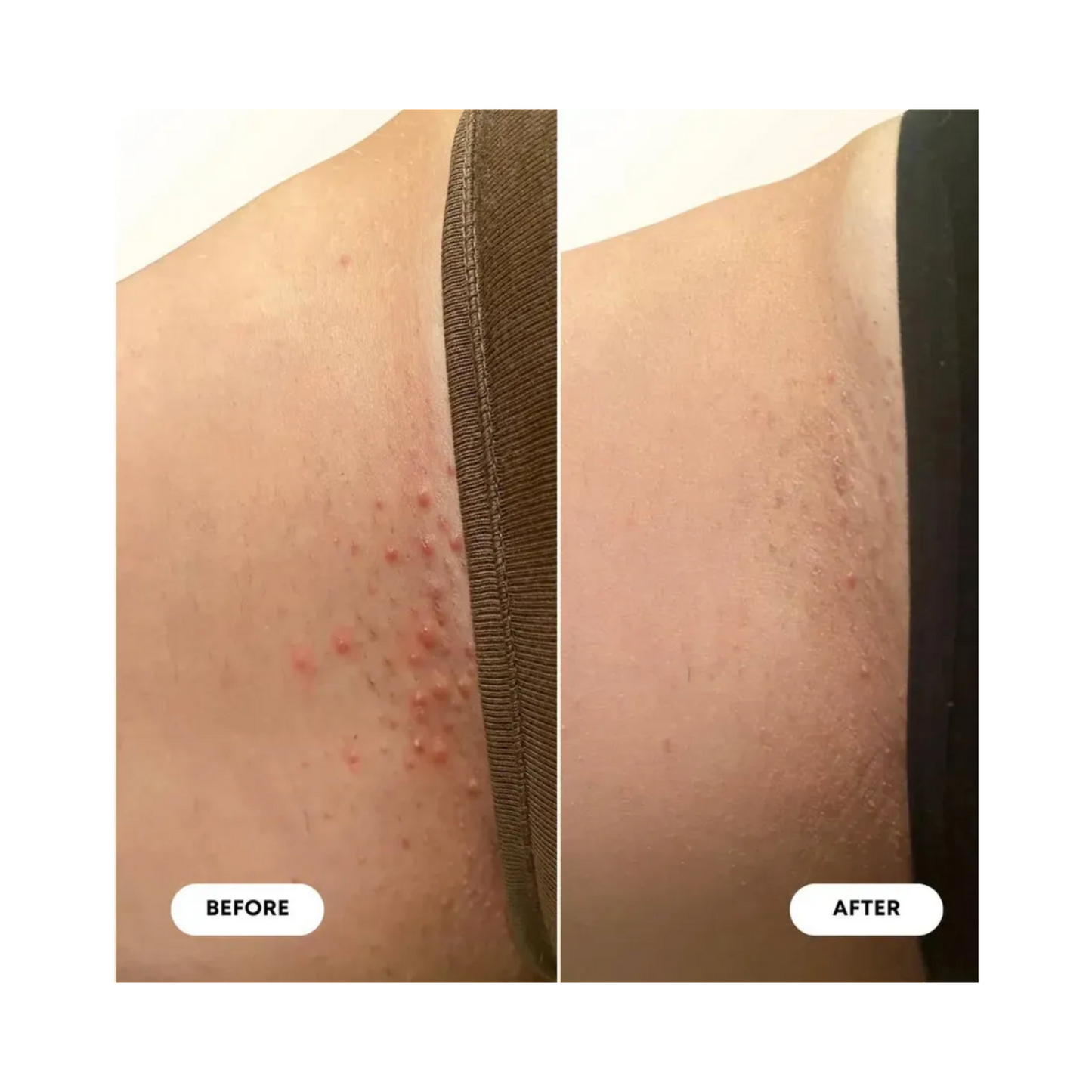 Bushbalm Vanilla Coconut Oil Ingrown Hair