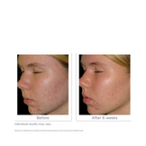 Glytone Acne Zelffoaming Cleanser