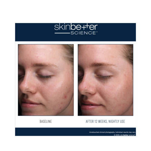Skinbetter Science AlphaRet Clearing Serum