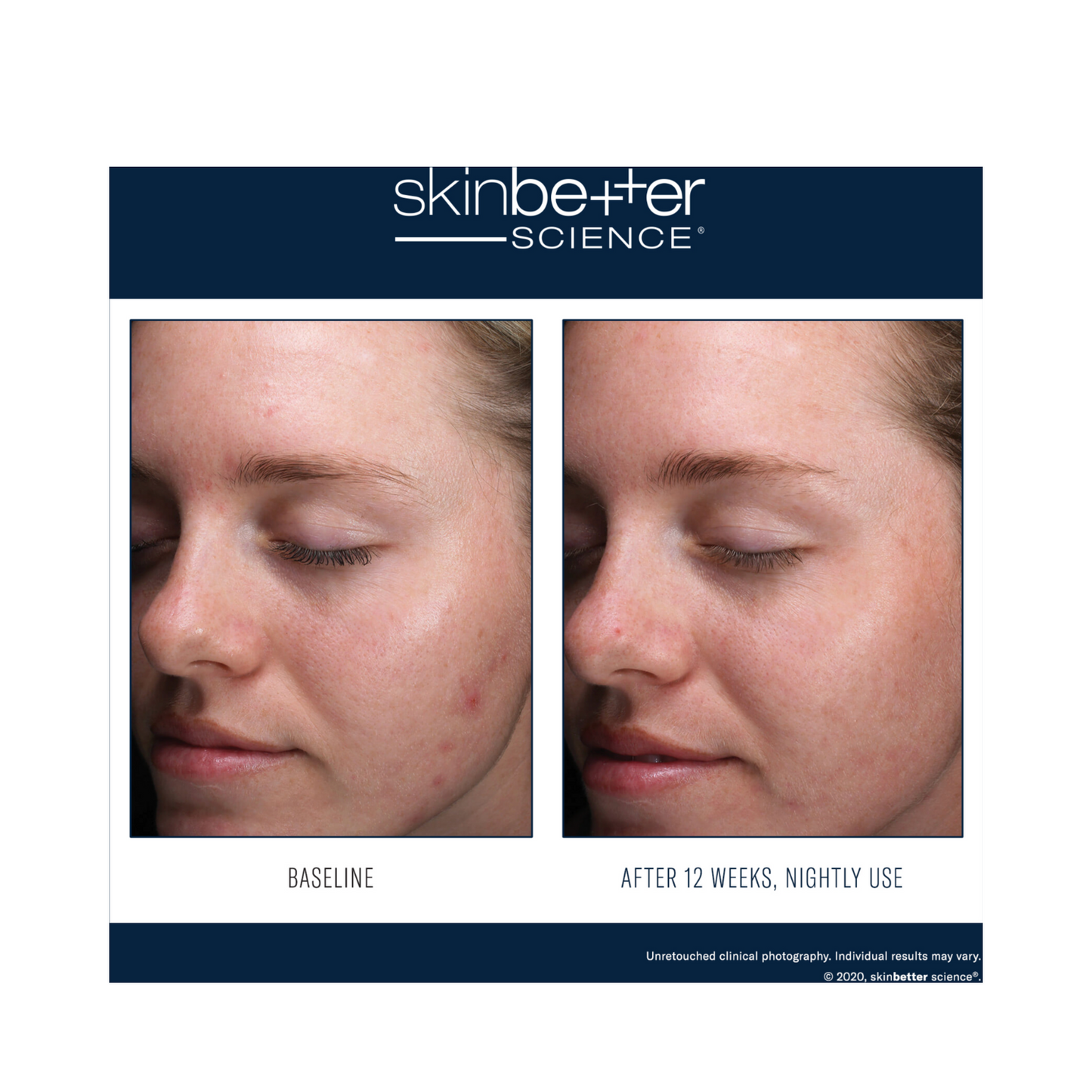 Before and after 12-week comparison of AlphaRet Clearing Serum use, showing reduced blemishes and improved skin clarity.