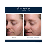 Before and after 12-week comparison of AlphaRet Clearing Serum use, showing reduced blemishes and improved skin clarity.