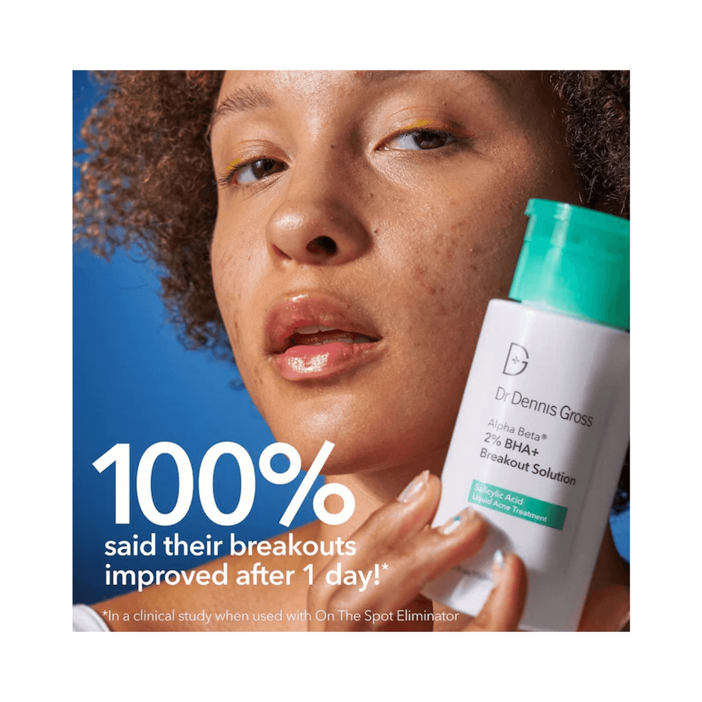 Model holding Dr Dennis Gross Breakout Solution, highlighting 100% breakout improvement after 1 day in clinical study.