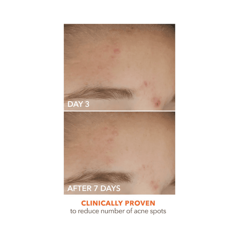 Before and after close-up of forehead showing reduced acne spots after 7 days using Dr Dennis Gross Spot Eliminator serum.