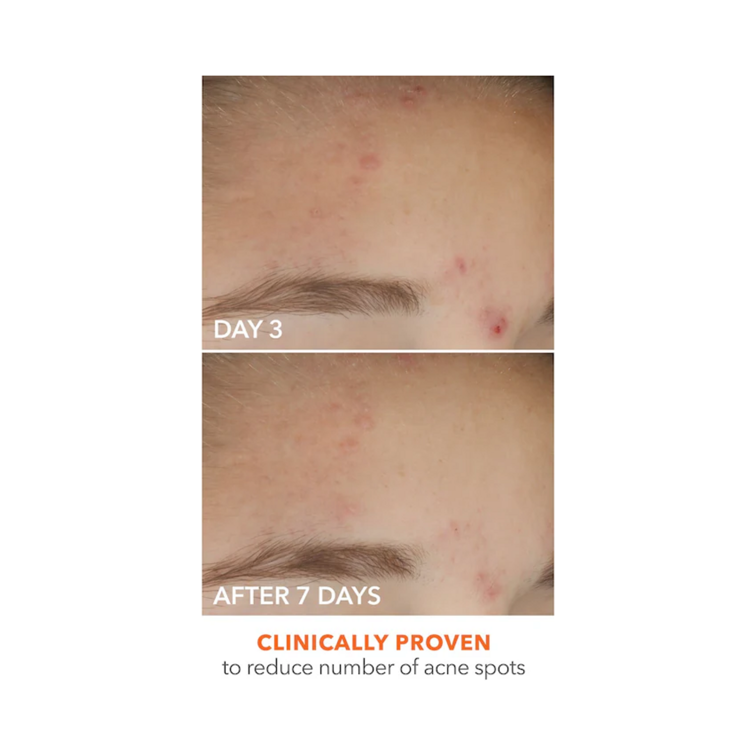 Visible acne reduction on forehead from day 3 to day 7 using Dr Dennis Gross Spot Eliminator, clinically proven for blemish relief.