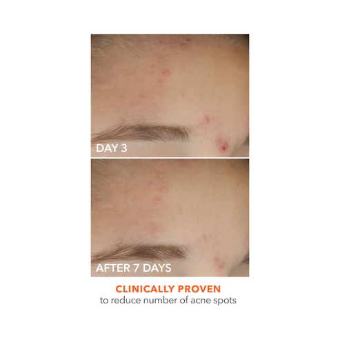 Visible acne reduction on forehead from day 3 to day 7 using Dr Dennis Gross Spot Eliminator, clinically proven for blemish relief.