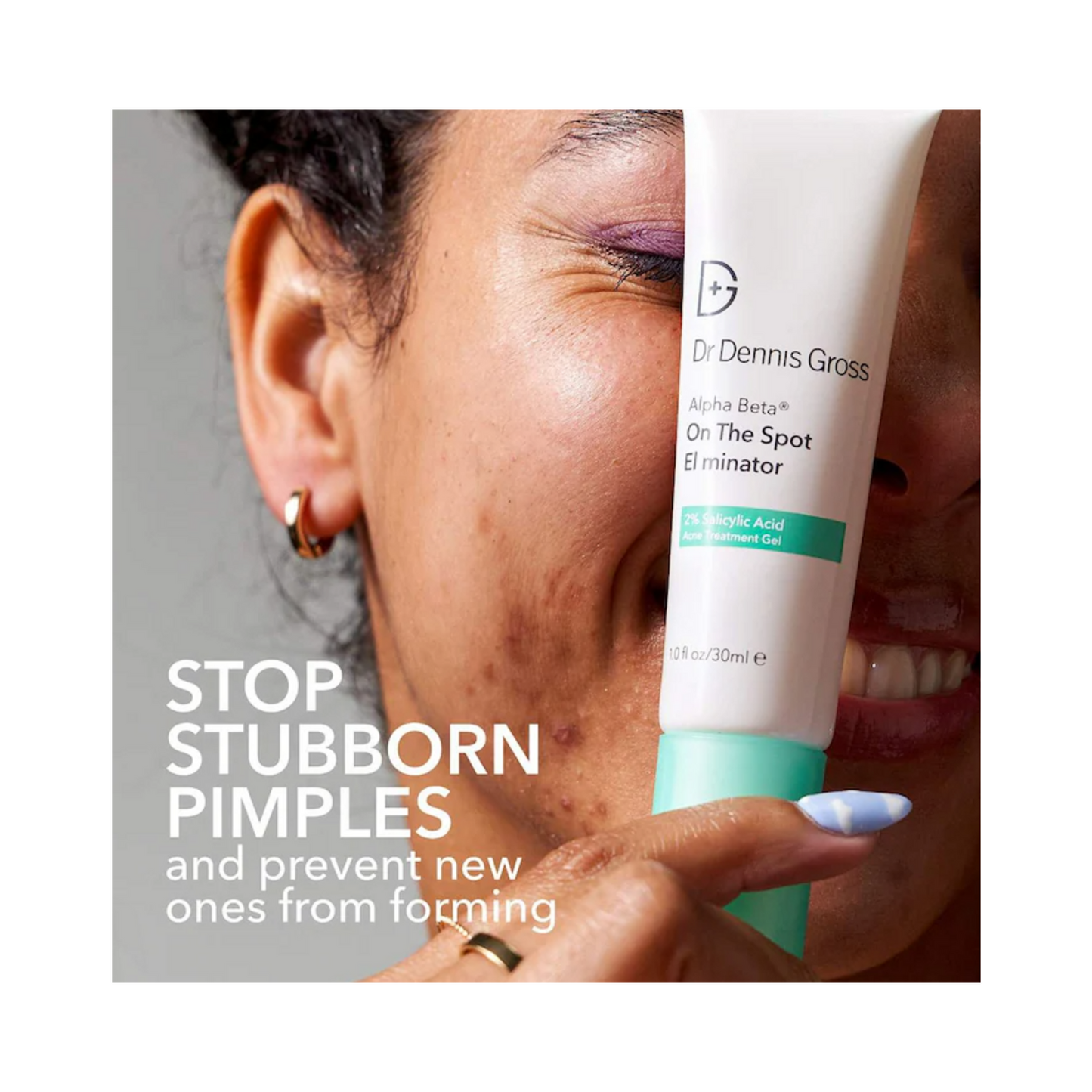 Close-up of woman smiling with Dr Dennis Gross Spot Eliminator, highlighting its power to stop pimples and prevent future breakouts.