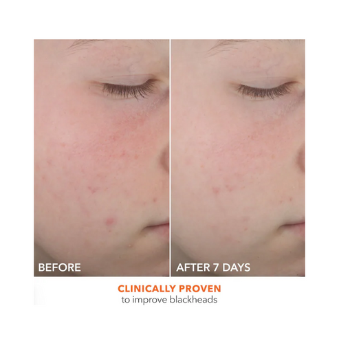 Before and after images of cheek showing reduced blackheads after 7 days of using Dr Dennis Gross Spot Eliminator acne treatment.