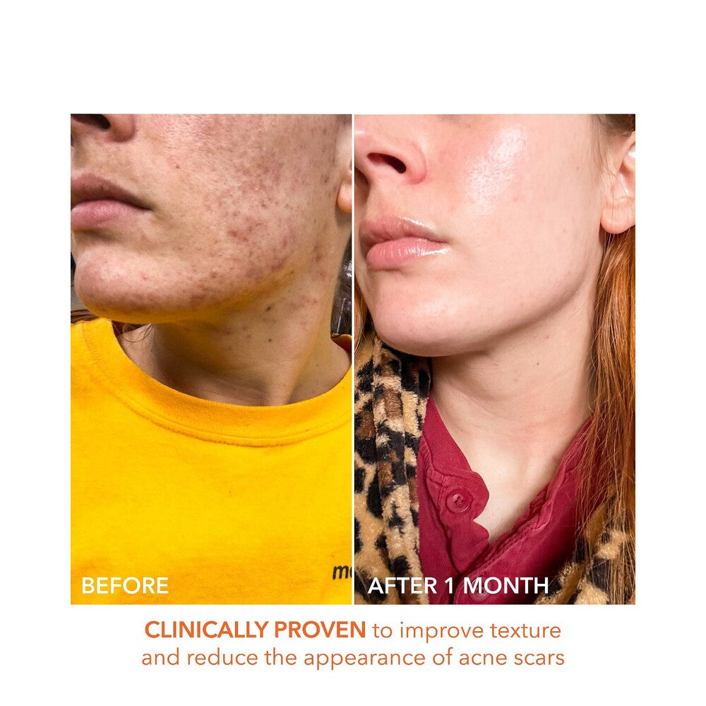 Before and after 1 month of Alpha Beta Peel use showing reduced acne scarring and enhanced skin clarity and texture.