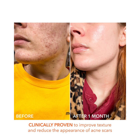 Before and after 1 month of Alpha Beta Peel use showing reduced acne scarring and enhanced skin clarity and texture.