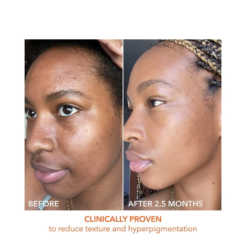 Alpha Beta Peel before and after 2.5 months showing improved skin tone, reduced hyperpigmentation, and smoother complexion.
