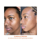 Alpha Beta Peel before and after 2.5 months showing improved skin tone, reduced hyperpigmentation, and smoother complexion.