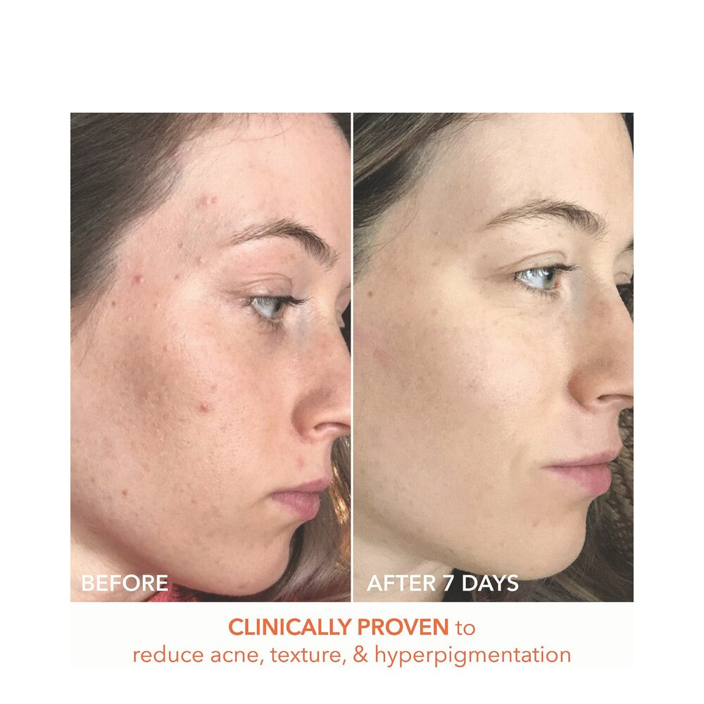 Visible results after 7 days of Alpha Beta Peel use showing clearer skin, reduced acne, and improved texture on a woman's face.