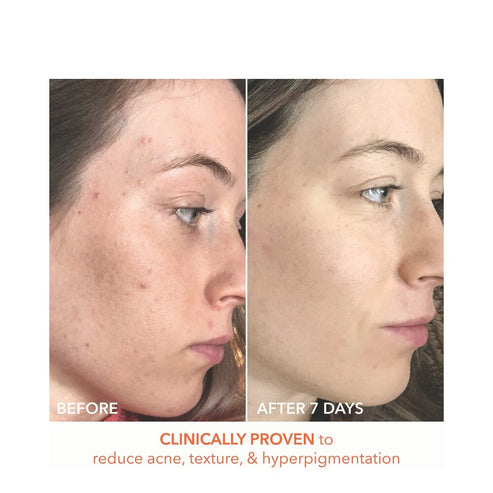 Visible results after 7 days of Alpha Beta Peel use showing clearer skin, reduced acne, and improved texture on a woman's face.