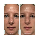 تشرق الهيدروبتيد البولندية ووجه قشرة الوجه ممتلئ