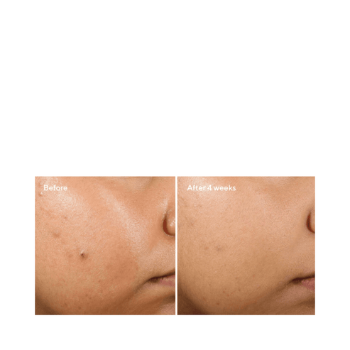Before and after 4 weeks of using Murad Clarifying Water Gel on cheek area, showing reduced blemishes and smoother skin texture.