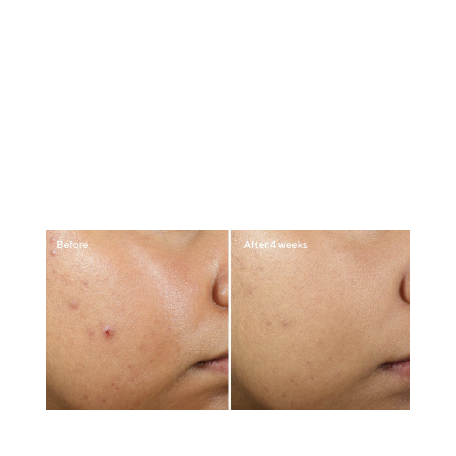Side-by-side comparison of cheek before and after 4 weeks of Murad Clarifying Water Gel use, showing reduced acne and smoother skin.