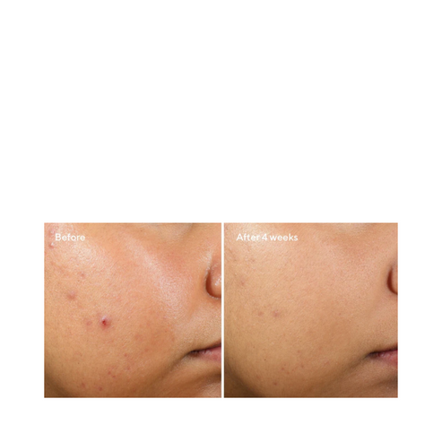 Side-by-side comparison of cheek before and after 4 weeks of Murad Clarifying Water Gel use, showing reduced acne and smoother skin.