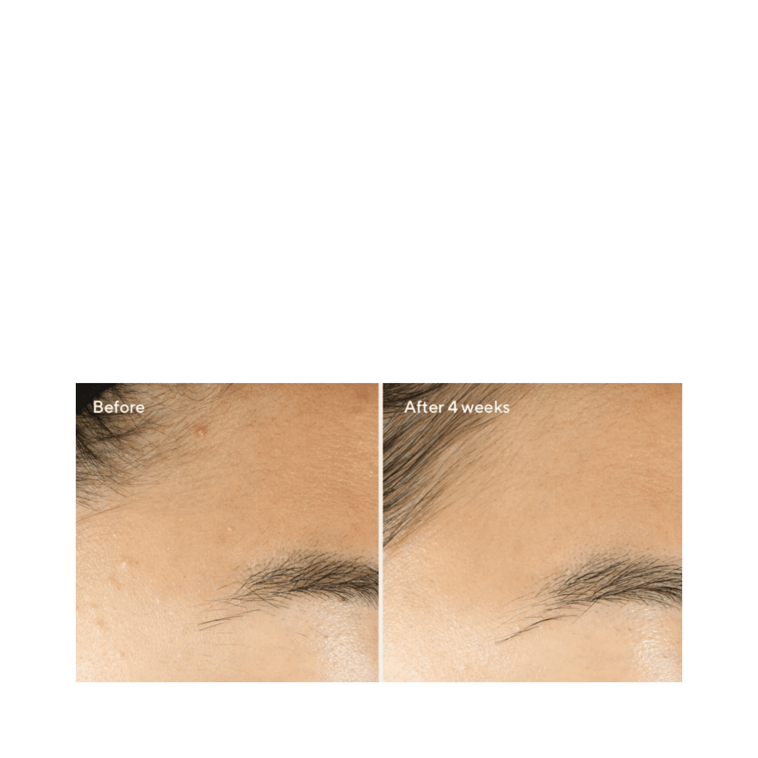 Close-up before and after 4 weeks of Murad Clarifying Water Gel on forehead, highlighting clearer, healthier-looking skin.