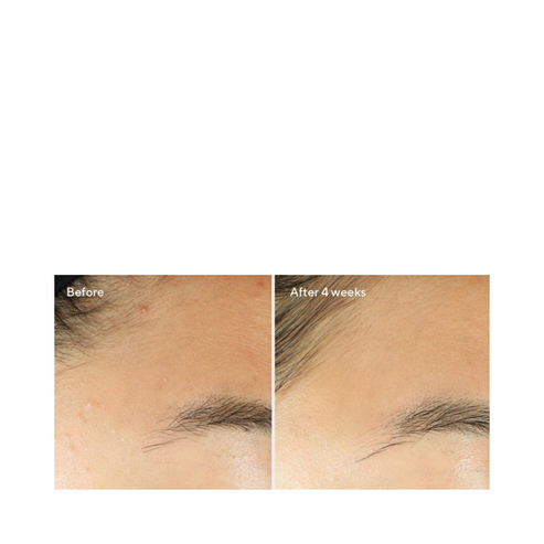 Forehead skin improvement shown before and after 4 weeks of Murad Clarifying Water Gel, with visible reduction in blemishes.