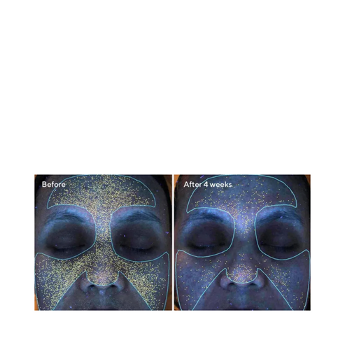 UV skin analysis before and after 4 weeks of Murad Clarifying Water Gel, illustrating clearer pores and reduced skin congestion.