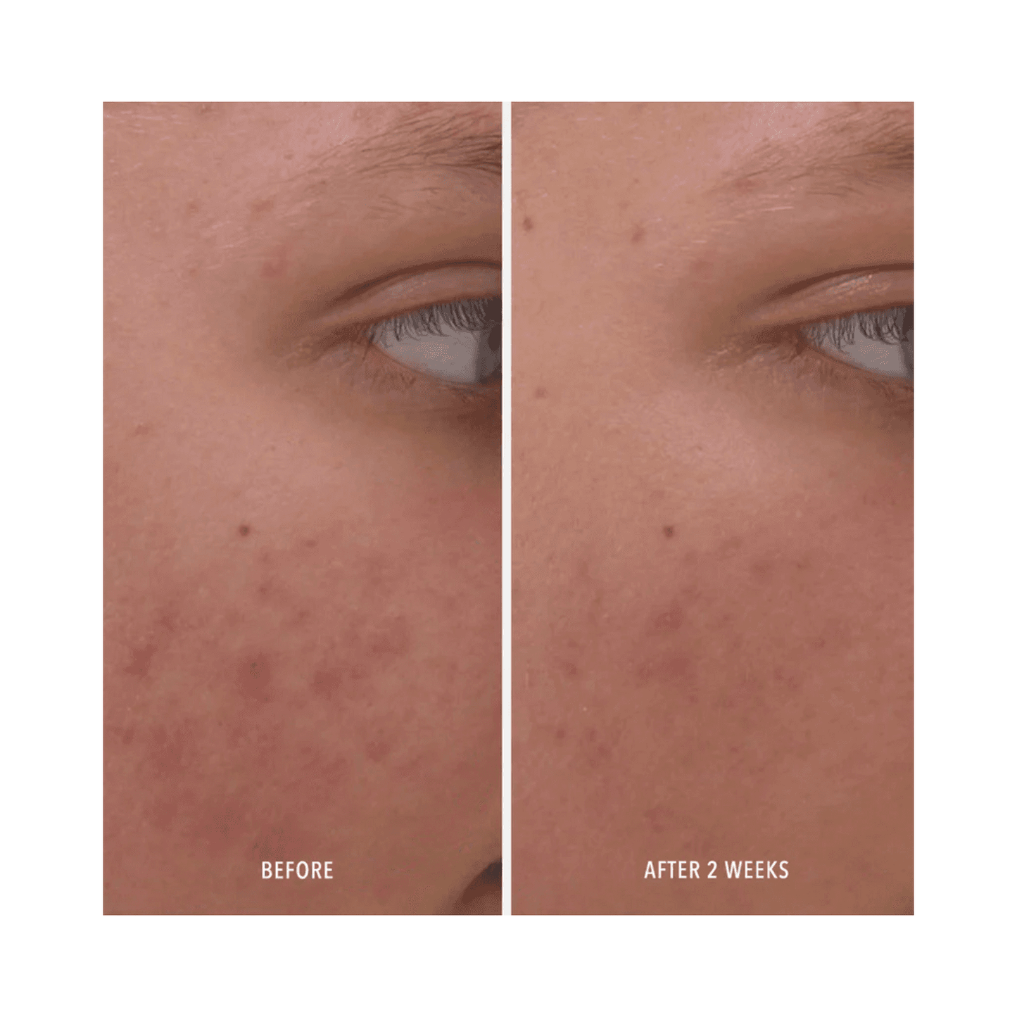 Before and after 2 weeks of using Clear Rescue Serum, showing visible acne reduction and improved skin clarity.