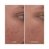 Before and after 2 weeks of using Clear Rescue Serum, showing visible acne reduction and improved skin clarity.