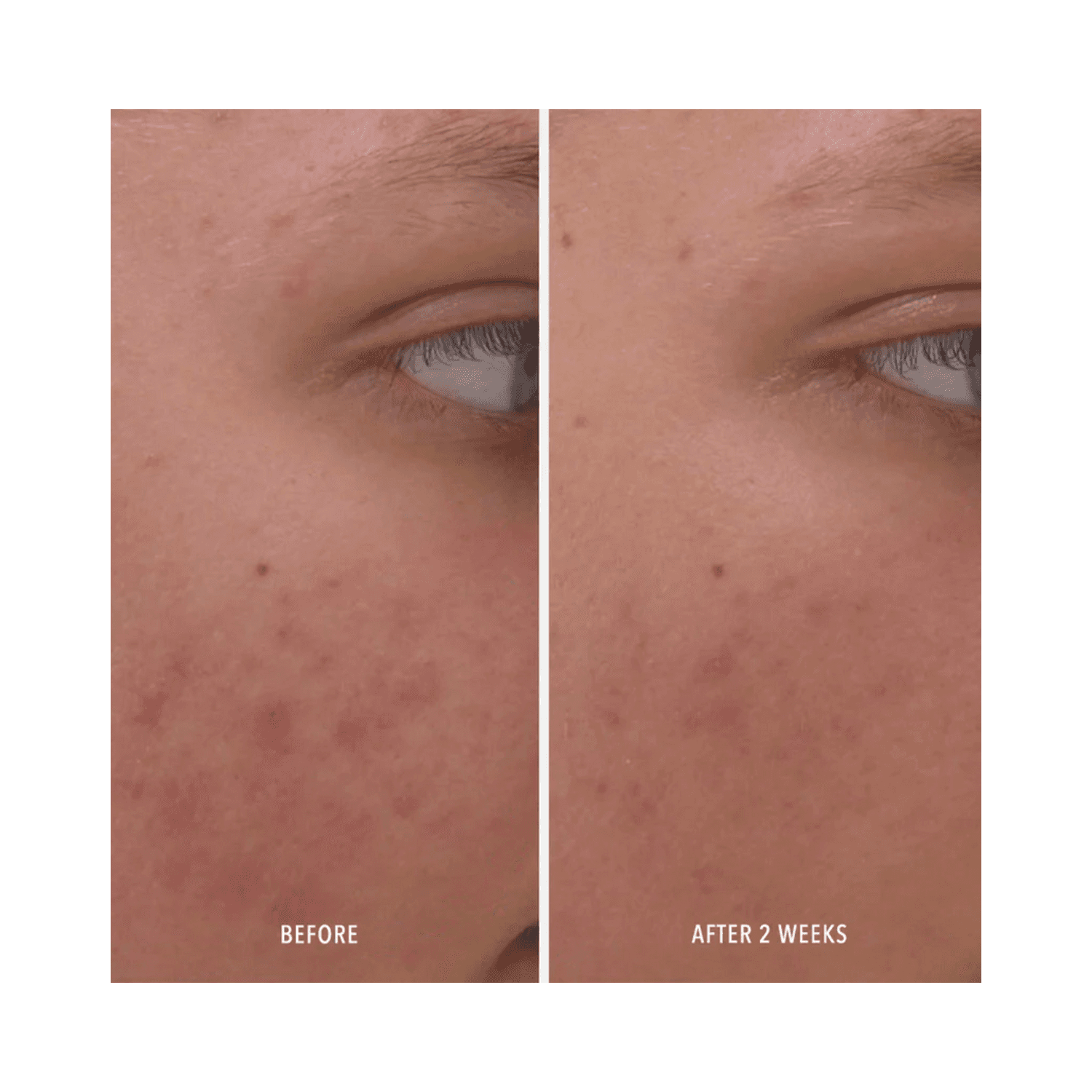 Before and after 2 weeks of using Clear Rescue Serum, showing visible acne reduction and improved skin clarity.
