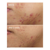 Visible skin improvement before and after using Murad Acne Treatment - Deep Relief Acne Treatment for 2 weeks.