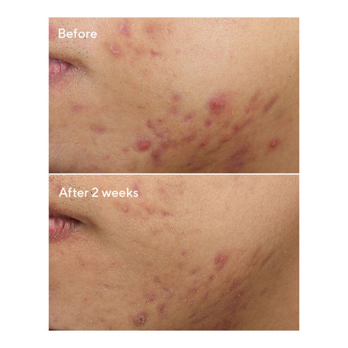 Visible skin improvement before and after using Murad Acne Treatment - Deep Relief Acne Treatment for 2 weeks.