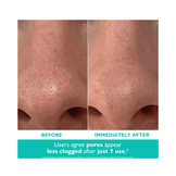 使用 Peter Thomas Roth 去角質霜進行毛孔護理前後的效果