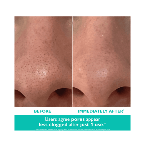 使用 Peter Thomas Roth 去角質霜進行毛孔護理前後的效果