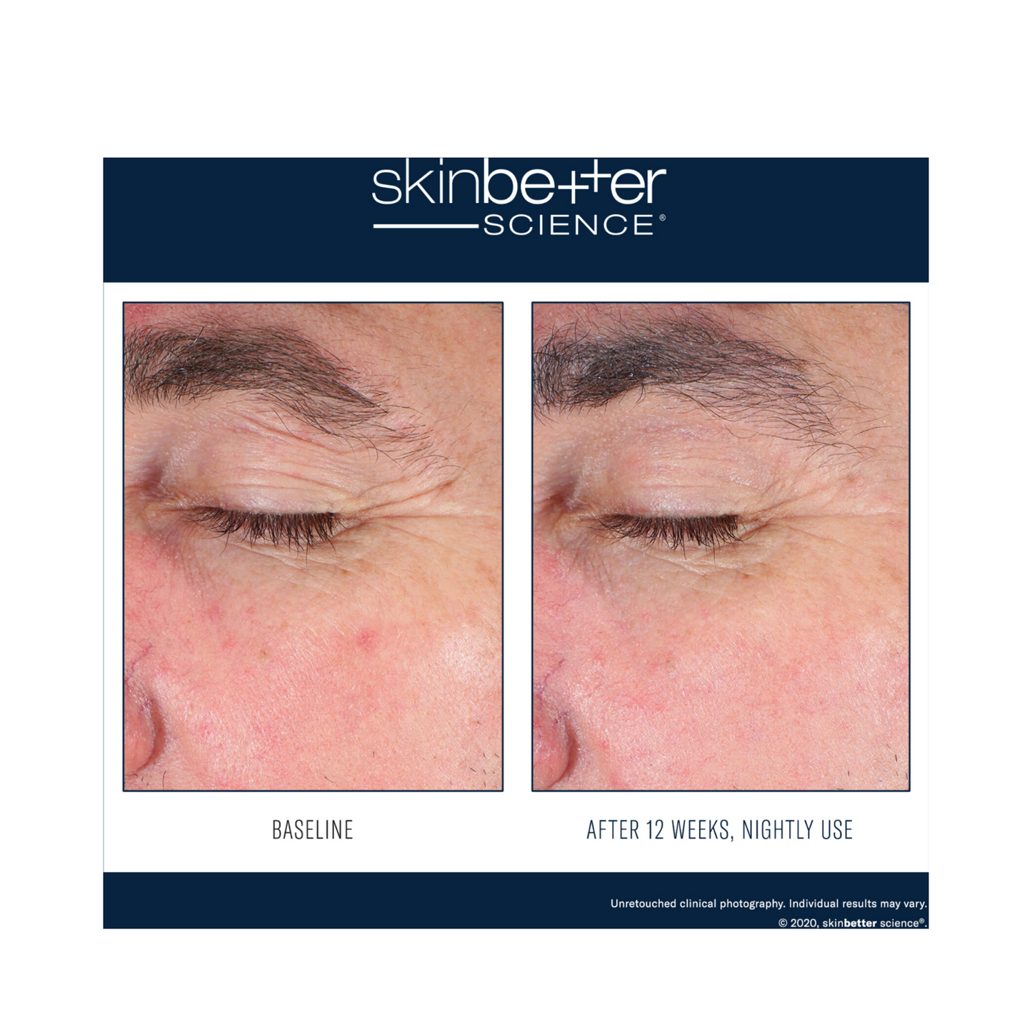 Before and after 12-week results of Skinbetter EyeMax AlphaRet Overnight Cream, showing visible reduction in wrinkles and smoother eye area.