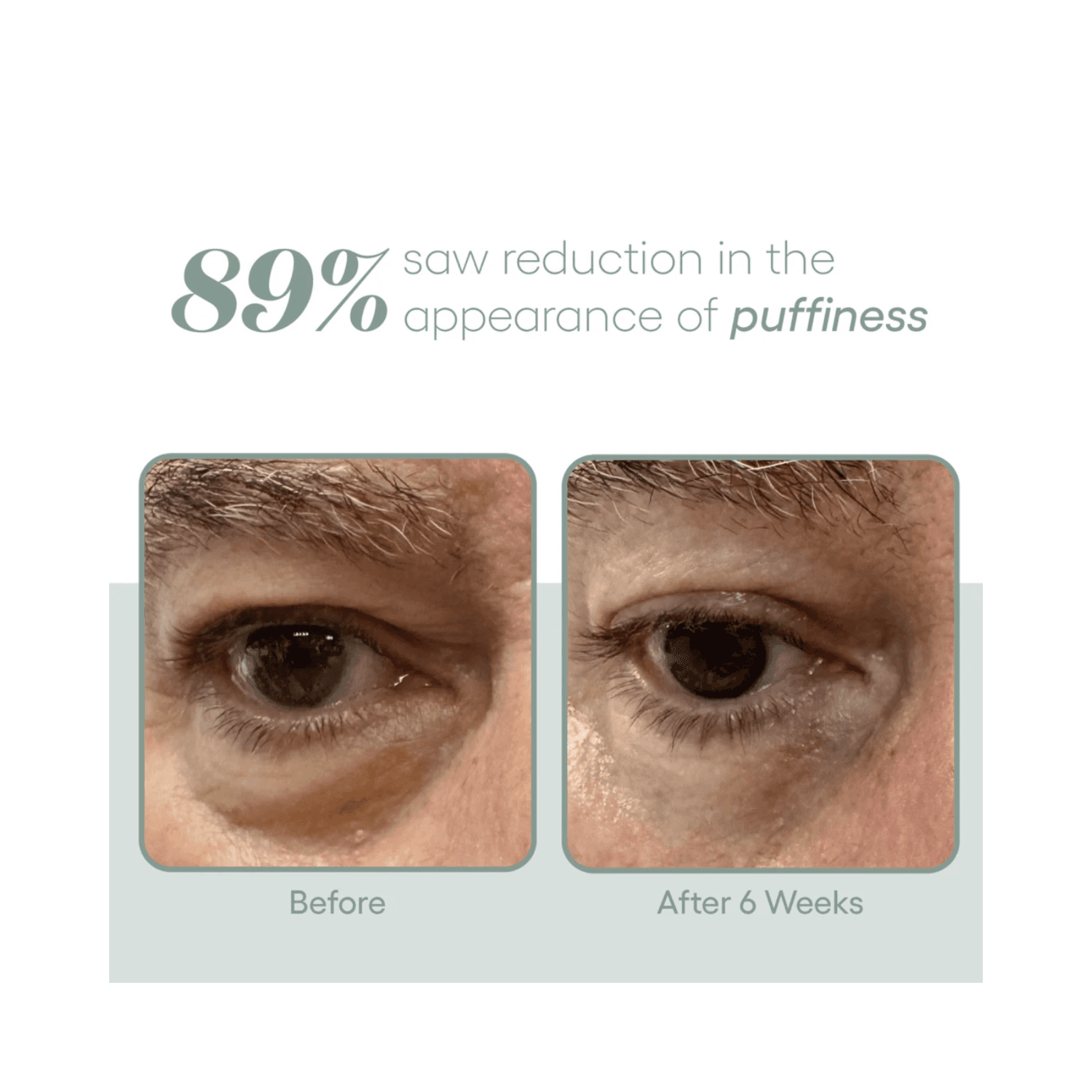 Before and after results showing 89% reduction in under-eye puffiness after 6 weeks using Plated Skin Science Eye Serum - Anti-Aging Eye Serum.
