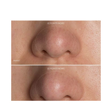 Foreo Kiwi Dispositivo di rimozione del punto nero - blu artico