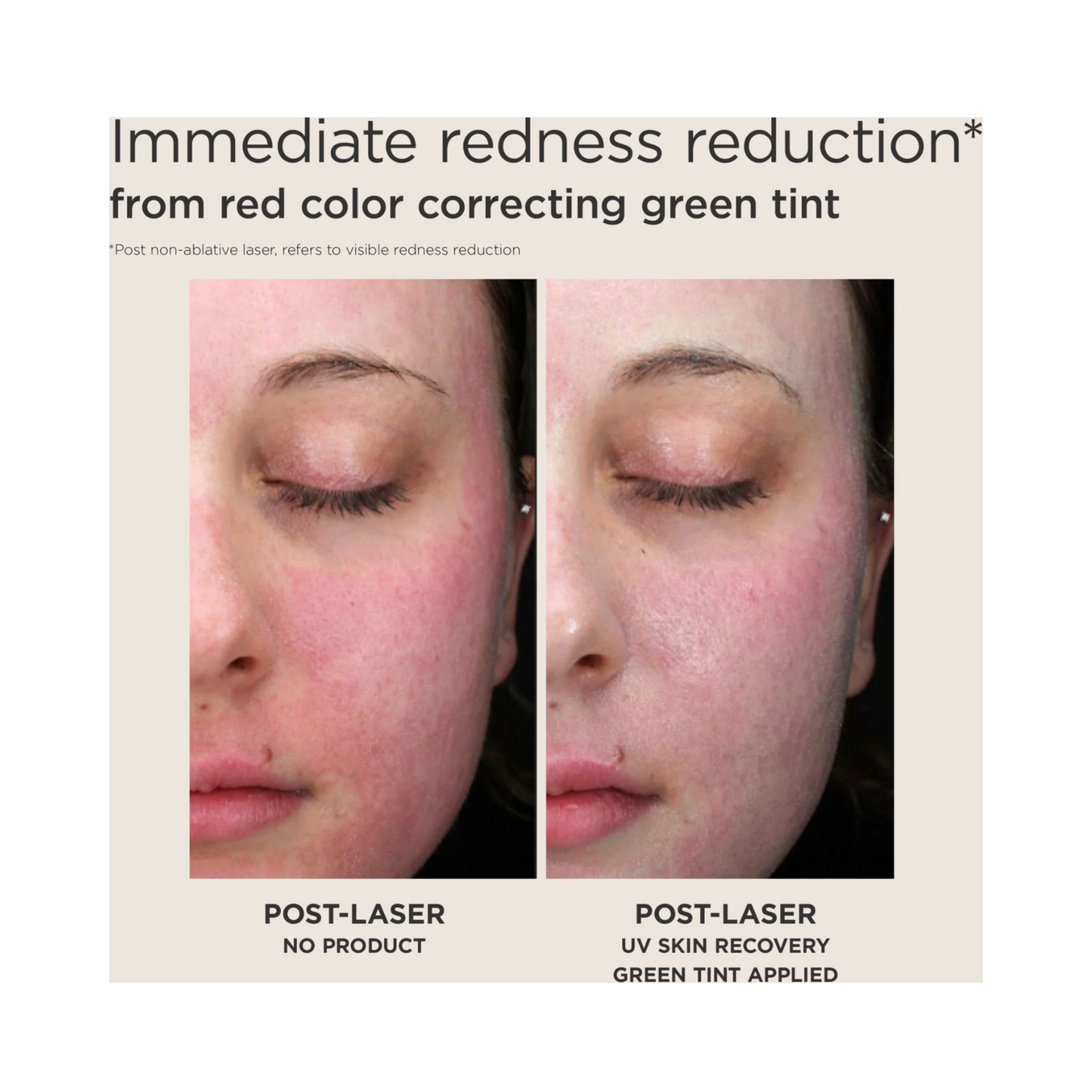 Before and after image showing EltaMD UV Skin Recovery SPF 50 visibly reduces redness on post-laser treated skin with green tint correction.