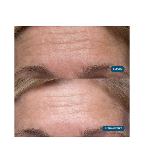 Before and after 4 weeks forehead comparison showing reduced wrinkles using Elemis Pro-Collagen Moisturizer. Enhances skin firmness and elasticity.