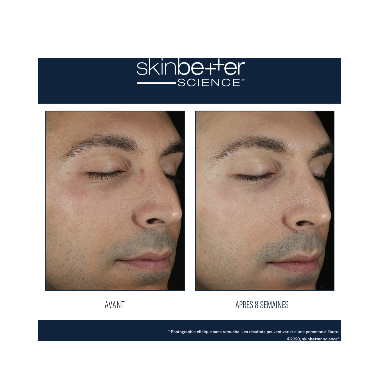 Before and after 8-week results of using Skinbetter Defense Moisturizer for Men, showing reduced redness and improved skin texture.