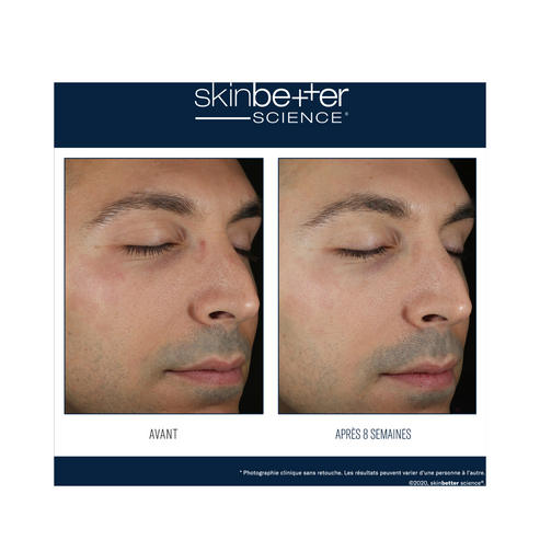Before and after 8-week results of using Skinbetter Defense Moisturizer for Men, showing reduced redness and improved skin texture.
