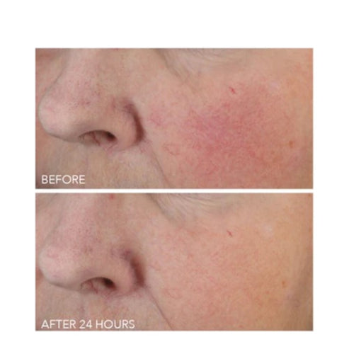 Side-by-side comparison of skin before and after 24 hours of using Dr Dennis Gross Vitamin C + Lactic Deep Cream, showing smoother texture.